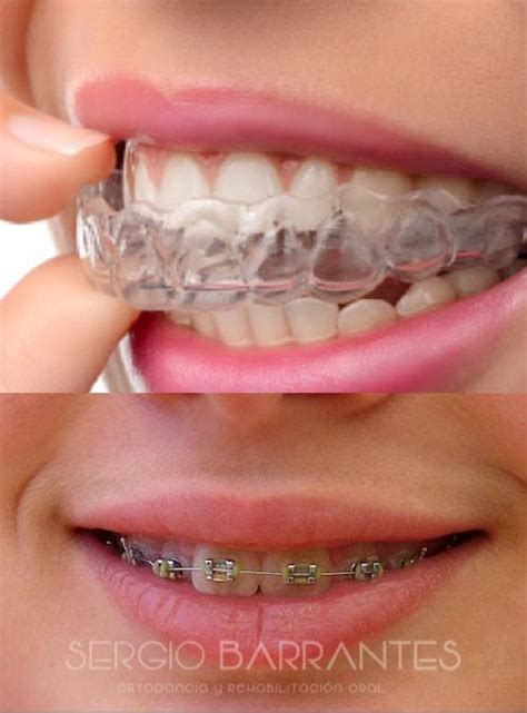 que es mejor los brackets esteticos o metalicos|brackets invisibles precio.